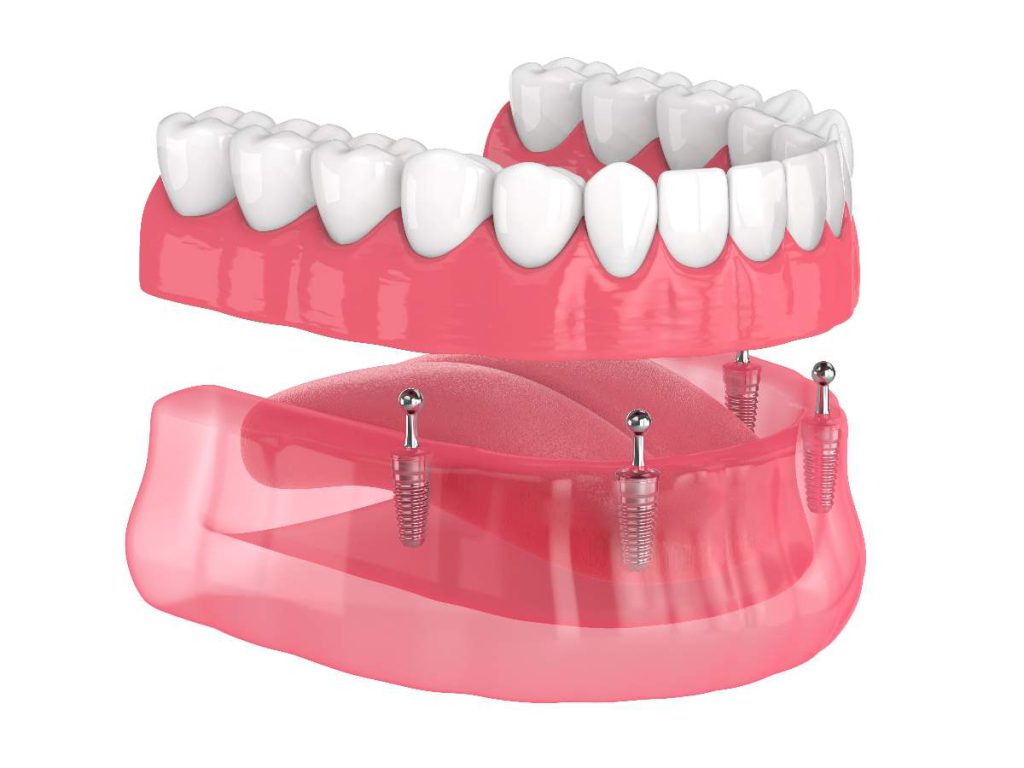 Removable dentures on implants