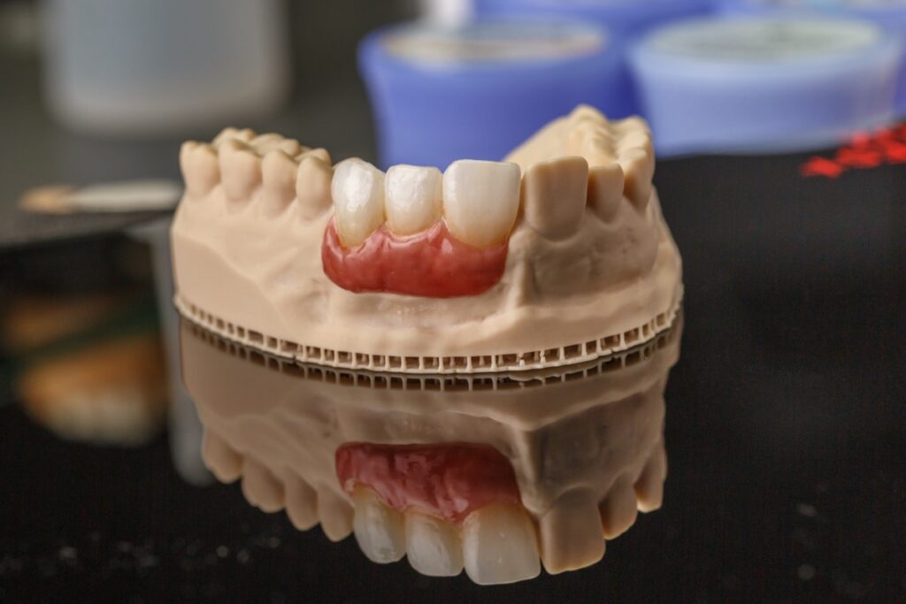 Dental implant. Restoration of teeth. Dental surgeon. Dental laboratory. Dental clinic. Implants of the jaw of a person. Visual materials at the dentist's office. Oral health.