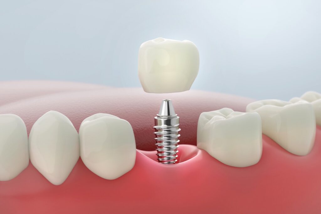 Single dental implant at molar teeth. 3D rendering.